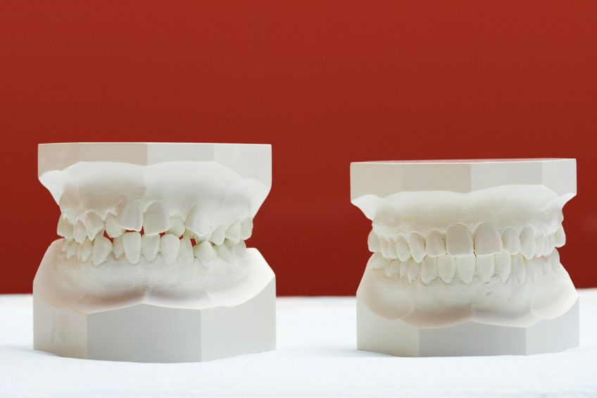 Gebiss-Abdrücke vor und nach der Zahnkorrektur