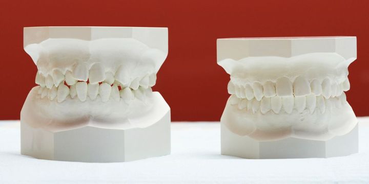 Gebiss-Abdrücke vor und nach der Zahnkorrektur
