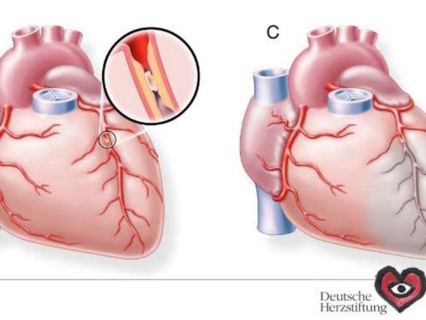 Abb.: Vollständiger Verschluss des Herzkranzgefäßes bei Herzinfarkt (B); Untergang von Herzmuskelgewebe im Areal unterhalb des Gefäßverschlusses (grau) (C)