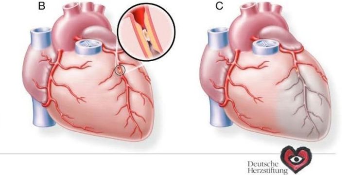 Abb.: Vollständiger Verschluss des Herzkranzgefäßes bei Herzinfarkt (B); Untergang von Herzmuskelgewebe im Areal unterhalb des Gefäßverschlusses (grau) (C)