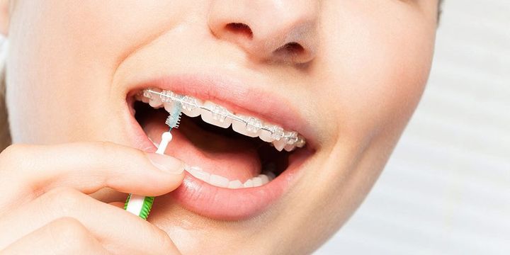 Frau mit fester Spange putzt Zähne mit Interdentalbürste