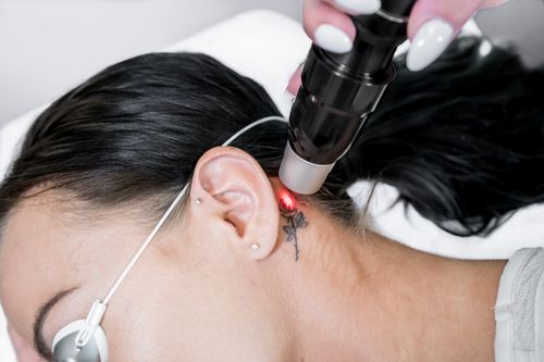 Frau bei der Tattoo-Entfernung hinter dem Ohr mit Laser