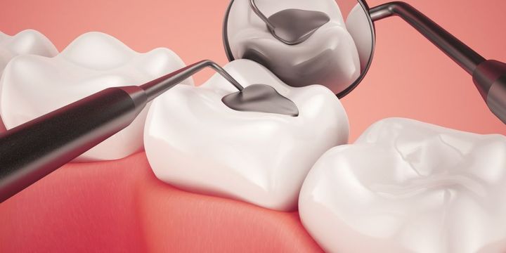 Modellbild einer Zahnfüllung mit Behandlungsbesteck